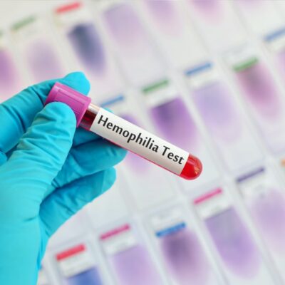 4 best foods for hemophilia