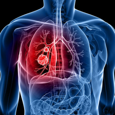 5 cities with the highest rates of lung cancer